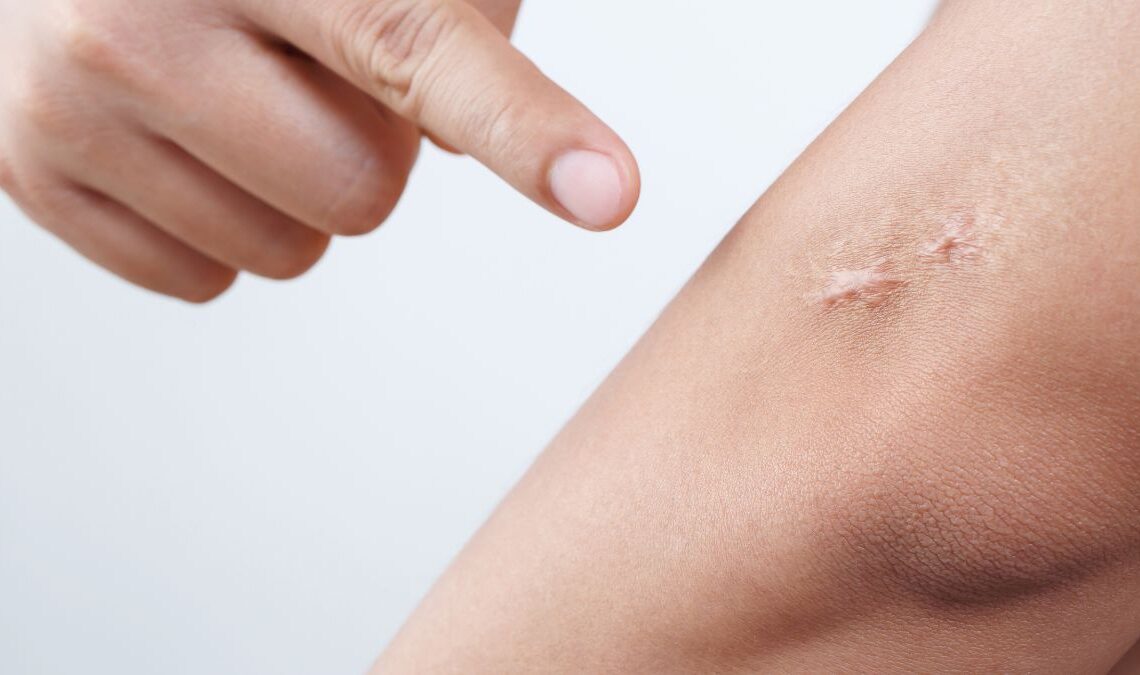 Can You Get Rid of Scar Tissue After Surgery, Injury, or Acne?