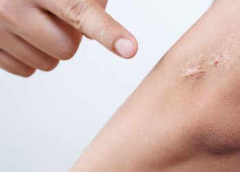 Can You Get Rid of Scar Tissue After Surgery, Injury, or Acne?