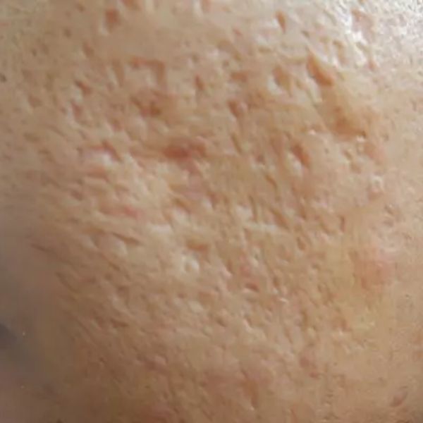 Atrophic or depressed acne scars