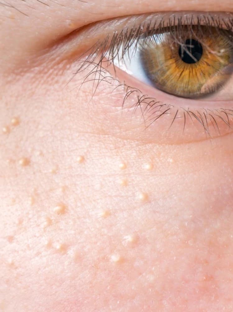 fungal acne symptoms