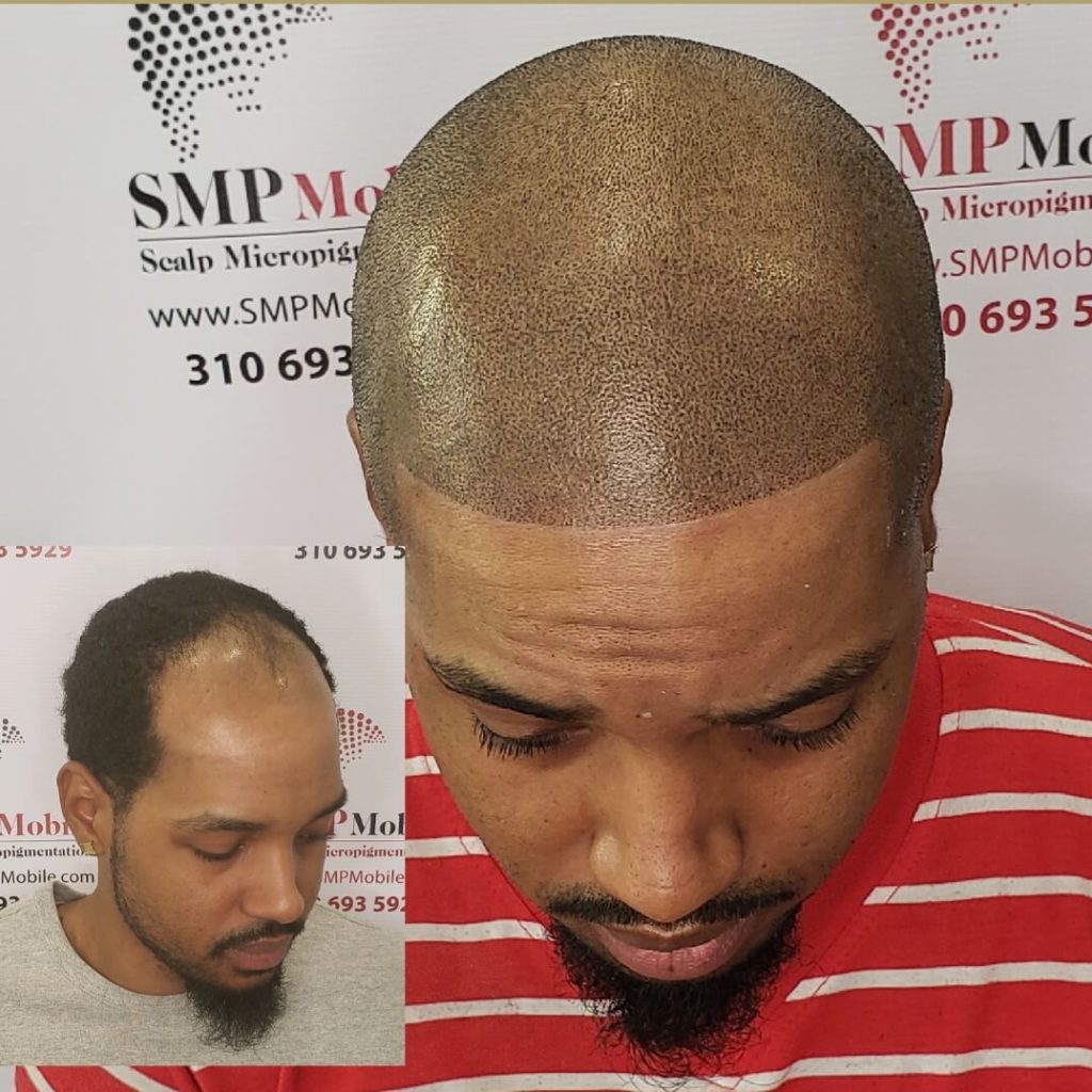 Before and After Scalp Micropigmentation